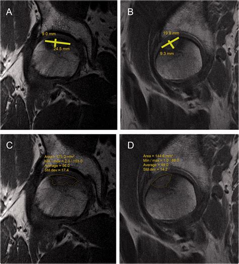 Magnetic Resonance Imaging Of Avascular Necrosis Of The, 47% OFF