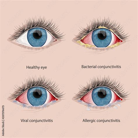 Conjunctivitis types.Eye disease Stock Illustration | Adobe Stock