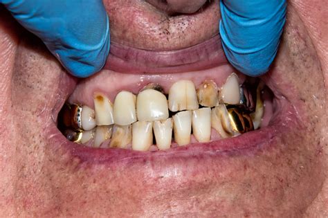 Rotten Teeth Extraction in HIV Patients | yapmt.org