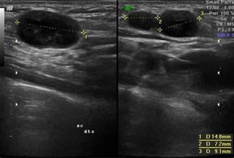 Swollen Lymph Nodes In Neck Ultrasound