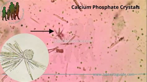 Amorphous Phosphate Crystals In Urine