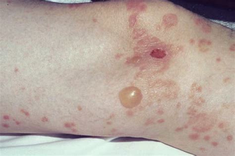 Diabetic blisters on feet pictures 1 | Symptoms and pictures