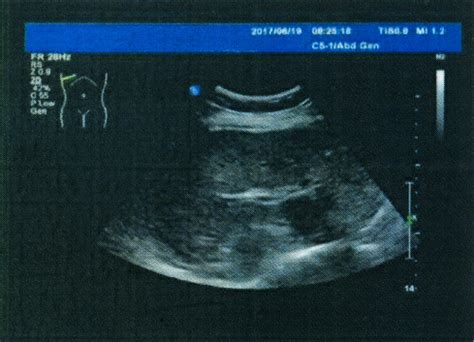 Liver Gallbladder Pancreas Spleen Kidney Adrenal Color Doppler Ultrasound Medical Examination ...