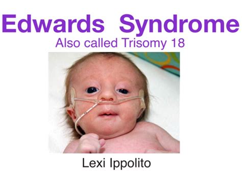 Edwards Syndrome Also Called Trisomy 18 Overview Symptoms Treatments | Images and Photos finder