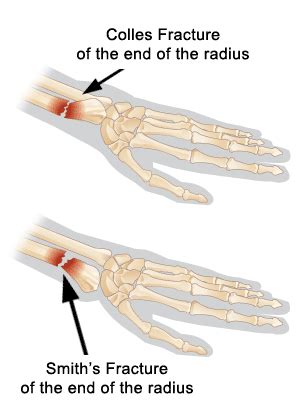 Colles Vs Smith Fracture - cloudshareinfo