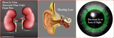 Living the Diagnosis: Living with Alport Syndrome