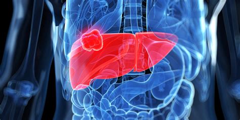 Diabetes Associated With Liver Cancer Risk | HuffPost