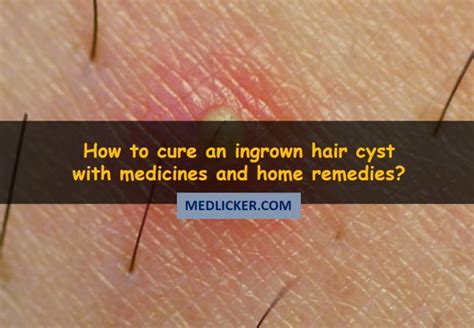 Ingrown Hair Cyst On Labia Majora - technohealthinfo