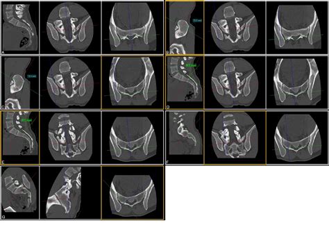 Figure 3 from The posterior superior iliac spine and sacral laminar slope: key anatomical ...