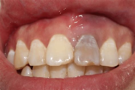 Discoloration of teeth after trauma. | Download Scientific Diagram