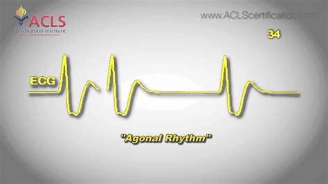 Agonal Rhythm