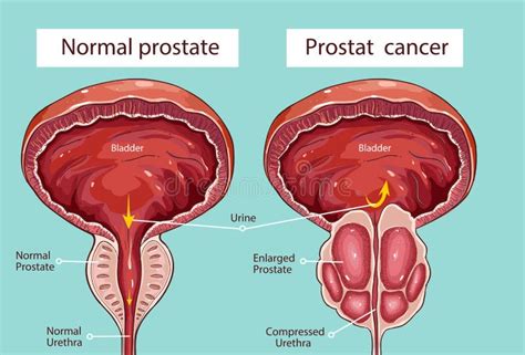 Prostaathypertrofie vector illustratie. Illustration of illustratie ...