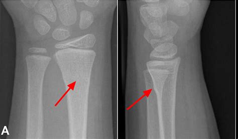 Greenstick Fracture Treatment