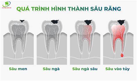 Trám răng sâu lỗ nhỏ: Phương pháp điều trị hiệu quả và an toàn cho nụ cười của bạn