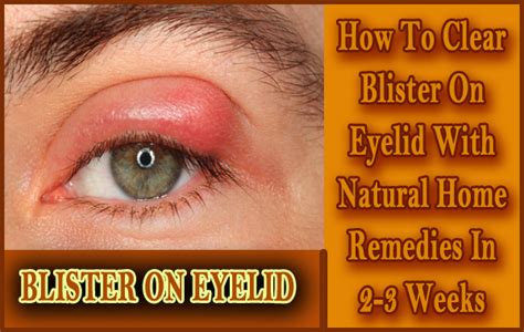 How To Clear Blister On Eyelid With Natural Home Remedies In 2-3 Weeks | Home remedies, Blister ...