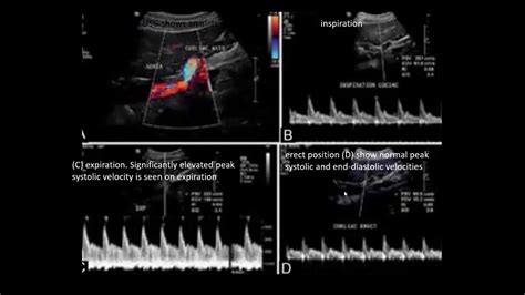 Median Arcuate Ligament Syndrome / Median Arcuate Ligament Syndrome ...