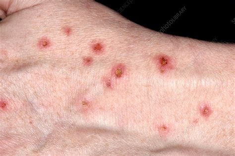 Infected nodular prurigo - Stock Image C038/1506 - Science Photo Library