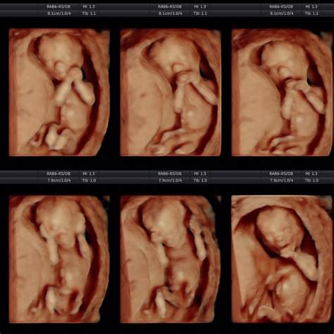 HD Live Ultrasound, 15 Weeks | Reveal Ultrasound Studio Gilbert