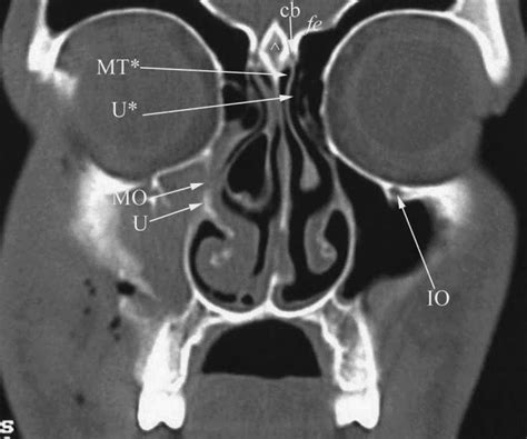 Radiology Anatomy Images : CT PNS anatomy