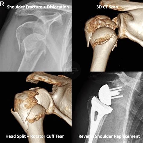 Shoulder Fracture with Dislocation | Medical Case Study | Sydney Shoulder Unit