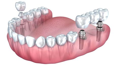 Implants | ARDENT CLINICS