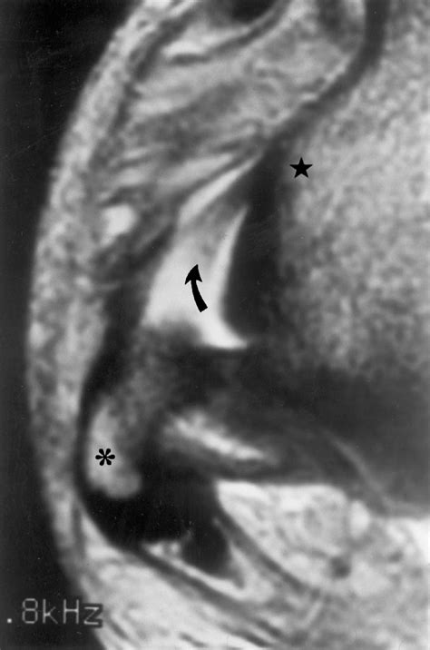 Acute complete proximal ATFL tear. Axial T2weighted MRI through the ...