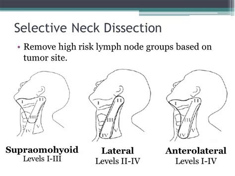 Neck lymph node dissection_02 (Note: "supraomohyoid" dissection is a ...