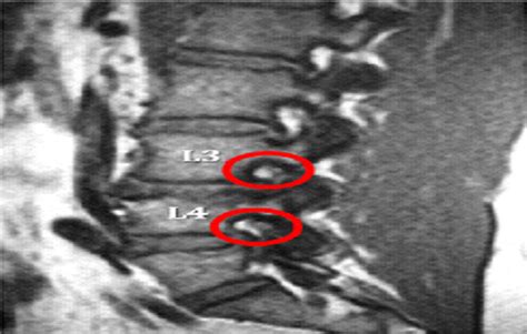 Foraminal Stenosis Mri