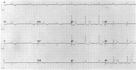 Electrocardiogram shows the old anterior myocardial infarction seven ...