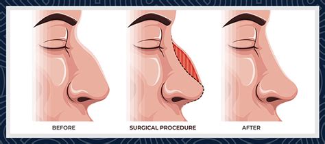 Rhinoplasty Turkey Cost Price 2024 - Smile Hair Clinic