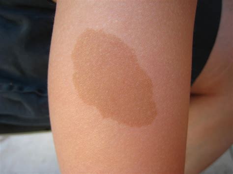 Uneven Skin Tone & Color - Causes & Treatment - How to Get Rid of It