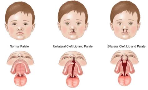 Cleft Lip/Palate & Craniofacial Anomalies in NE Calgary