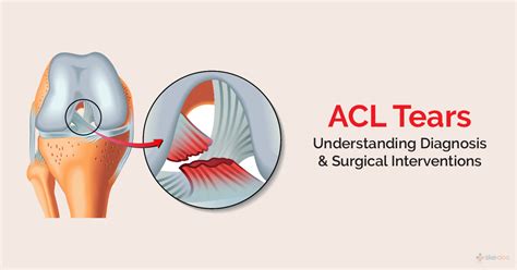 ACL Tear - Causes, Symptoms, Treatment and Prevention