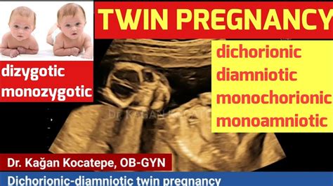 Twin pregnancy types(dichorionic-diamniotic),(monochorionic-diamniotic ...