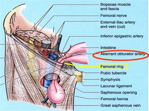 Anatomy of inguinal and femoral hernias - Inguinal and Femoral Hernia