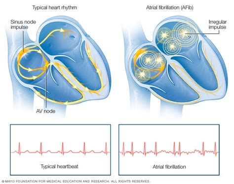 Atrial fibrillation - Symptoms and causes - Mayo Clinic