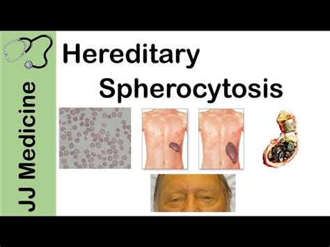 Hereditary Spherocytosis