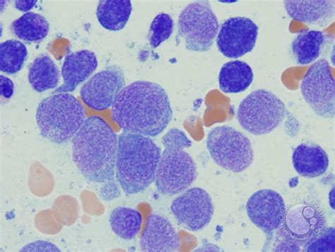 Acute Monoblastic and Monocytic Leukemia - 4.