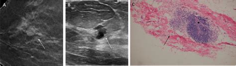 Periductal mastitis in a 55-year-old woman. a Right CC mammographic... | Download Scientific Diagram