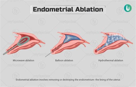 Endometrial ablation: Procedure, Purpose, Results, Cost, Price ...