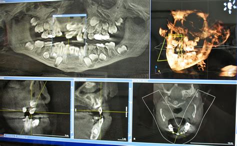 Rachel's Journey: A Dental CT Scan