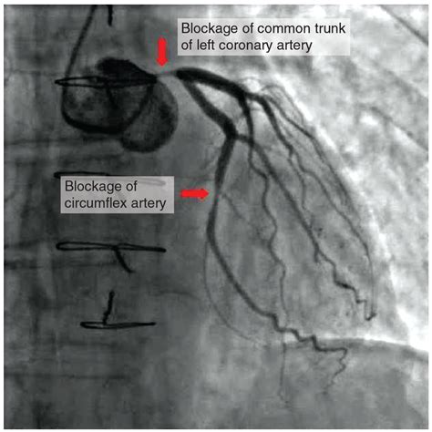 Cardiovascular System – Heart – Building a Medical Terminology Foundation