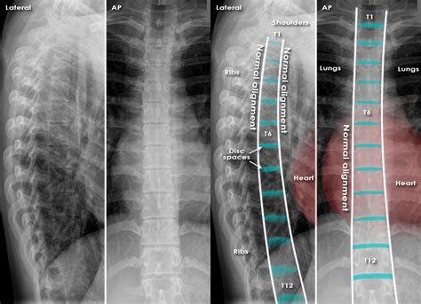 Trauma X-ray - Axial skeleton - Thoracolumbar spine - Normal anatomy