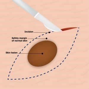 Your Guide To Mole Removal In Singapore | Dream Plastic Surgery