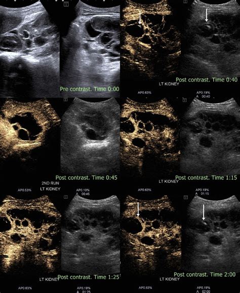 Complex renal cyst. Noncontrast ultrasound shows a large renal cyst... | Download Scientific Diagram