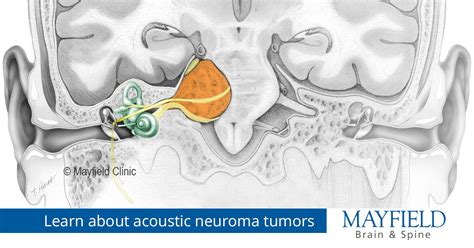 Acoustic Neuroma, vestibular schwannoma | Cincinnati, OH Mayfield Brain ...