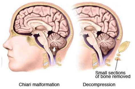 Chiari Malformation Adelaide | Hydrocephalus Treatment Adelaide SA