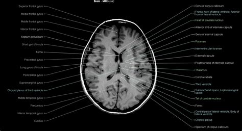 Brain MRI - NeurologyNeeds.com | Brain, Mri, Arc of the covenant