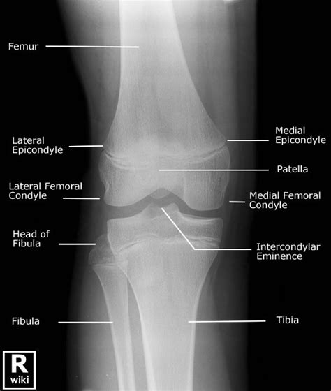 Radiographic Anatomy - Knee AP | Knee joint anatomy, Radiology student, Medical anatomy