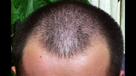 The effects of minoxidil, 1% pyrithione zinc and a combination of both ...